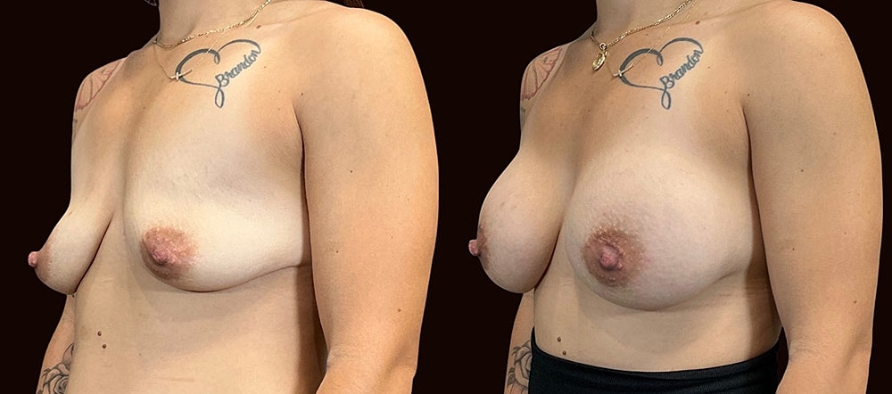 Before and after breast augmentation photos.