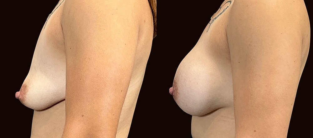 Before and after breast surgery comparison.