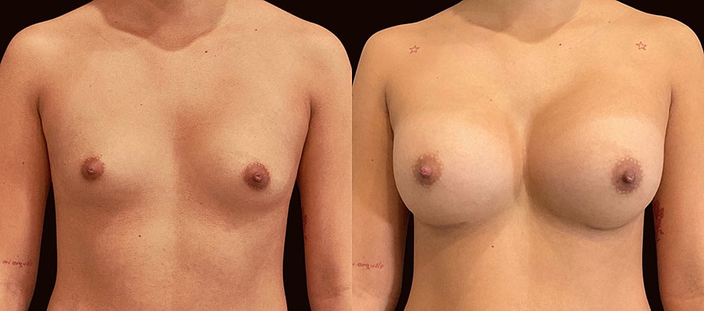 Before and after breast enhancement comparison.