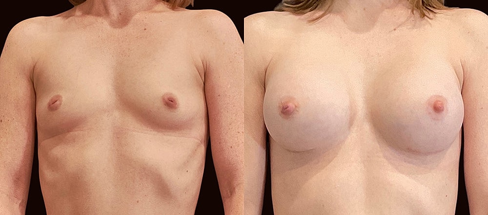 Comparison of breast appearance before and after.