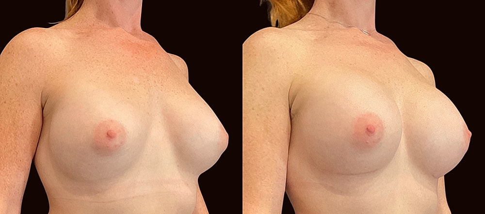 Before and after chest appearance comparison.