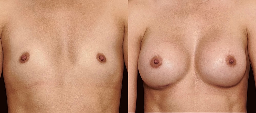 Before and after breast augmentation comparison.