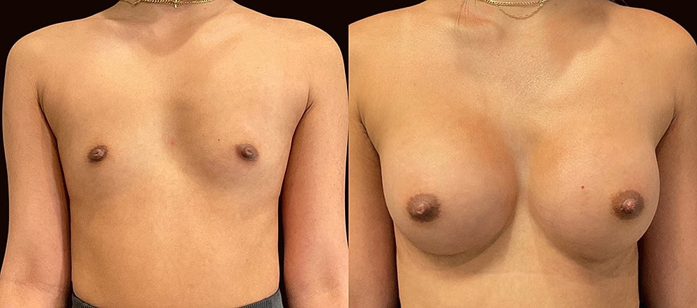 Before and after breast augmentation comparison.
