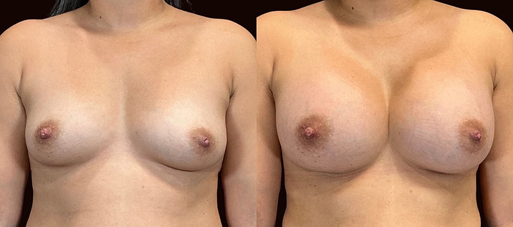 Before and after breast augmentation images.