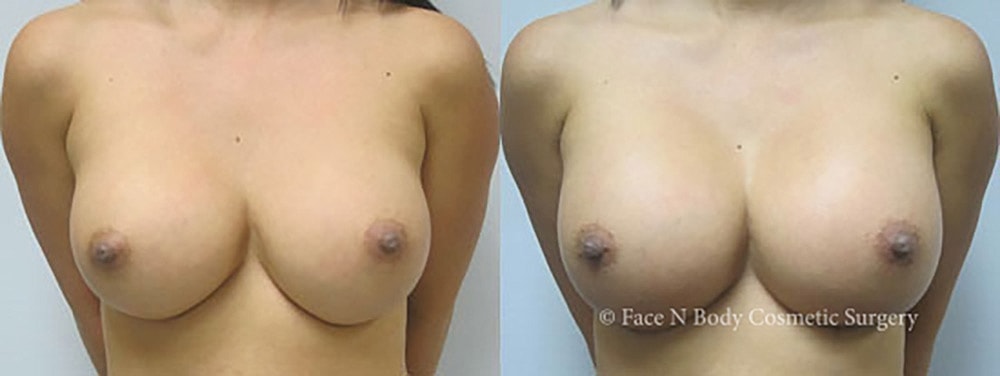 Breast Augmentation Before & After