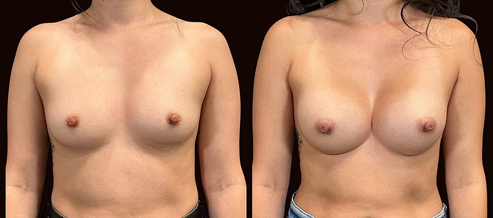 Before and after breast enhancement photos.