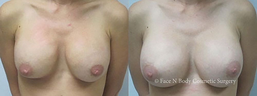Breast Augmentation Before & After