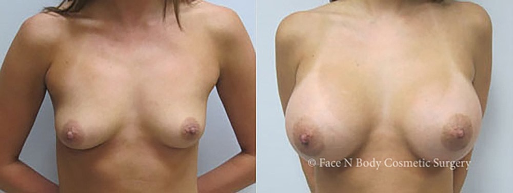 Breast Augmentation Before & After