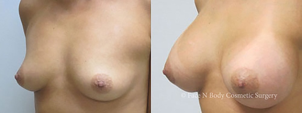 Breast Augmentation Before & After