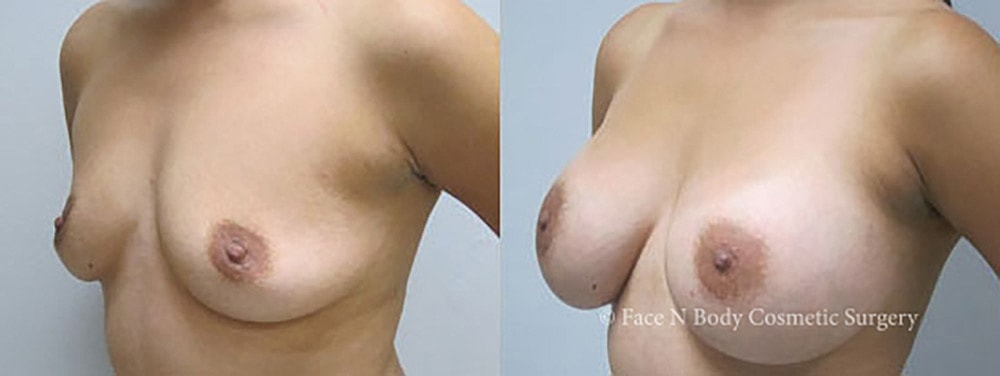 Breast Augmentation Before & After