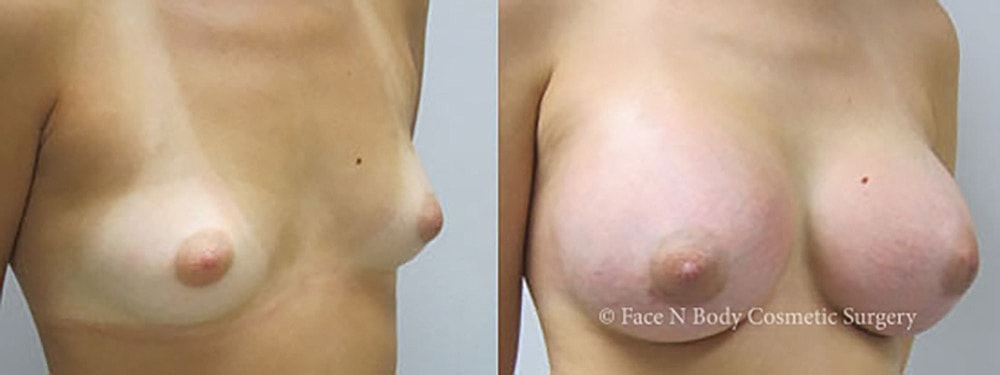 Breast Augmentation Before & After