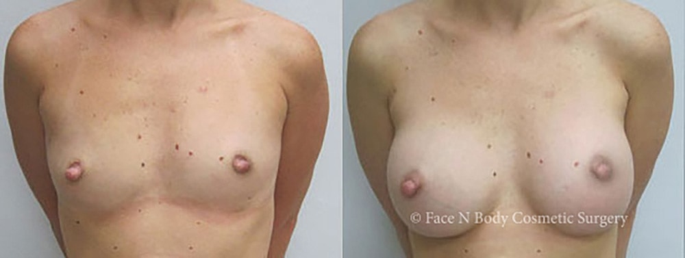 Breast Augmentation Before & After