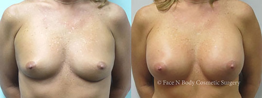 Breast Augmentation Before & After