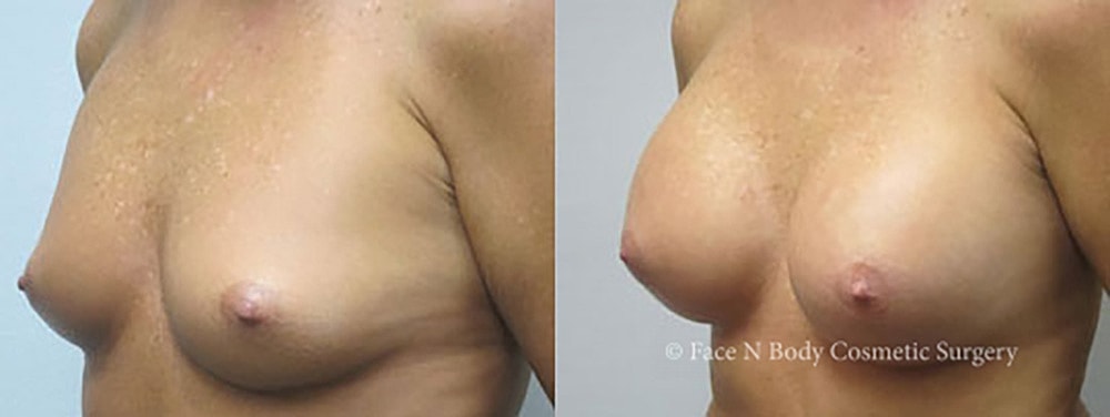 Breast Augmentation Before & After