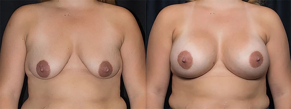 Breast Augmentation Before & After