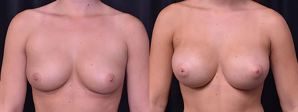 Breast Augmentation Before & After