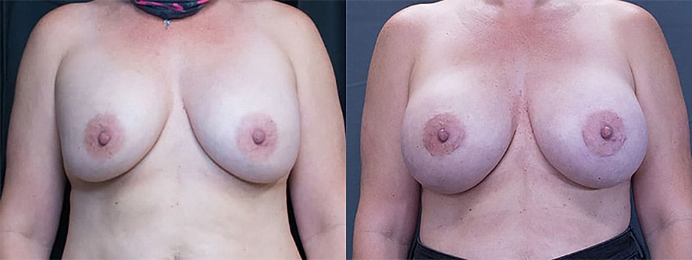 Breast Augmentation Before & After