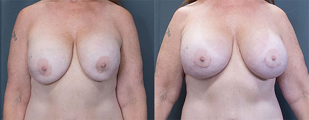 Breast Augmentation Before & After