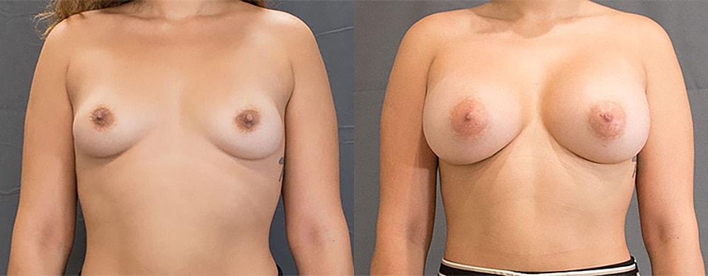 Breast Augmentation Before & After