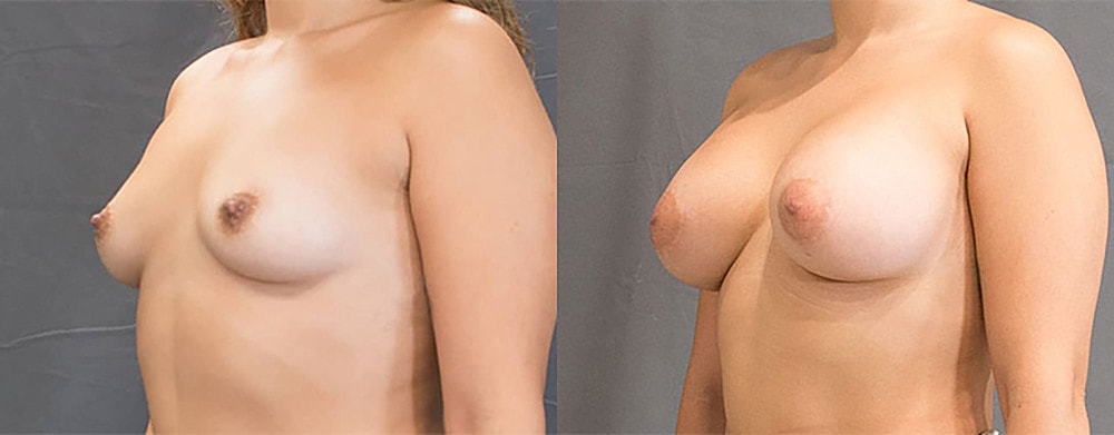 Breast Augmentation Before & After