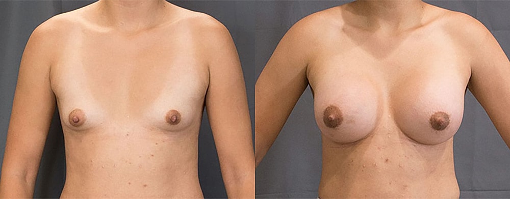 Breast Augmentation Before & After