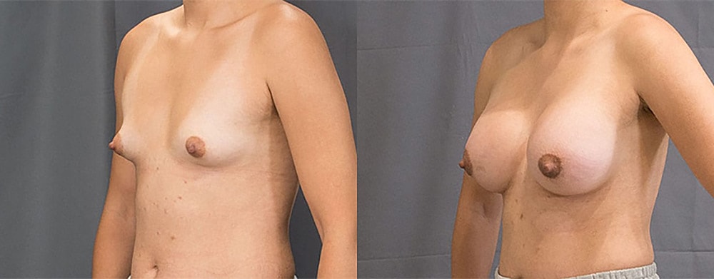 Breast Augmentation Before & After