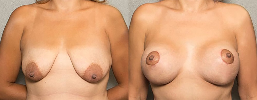 Breast Augmentation Before & After