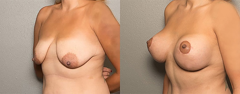 Breast Augmentation Before & After