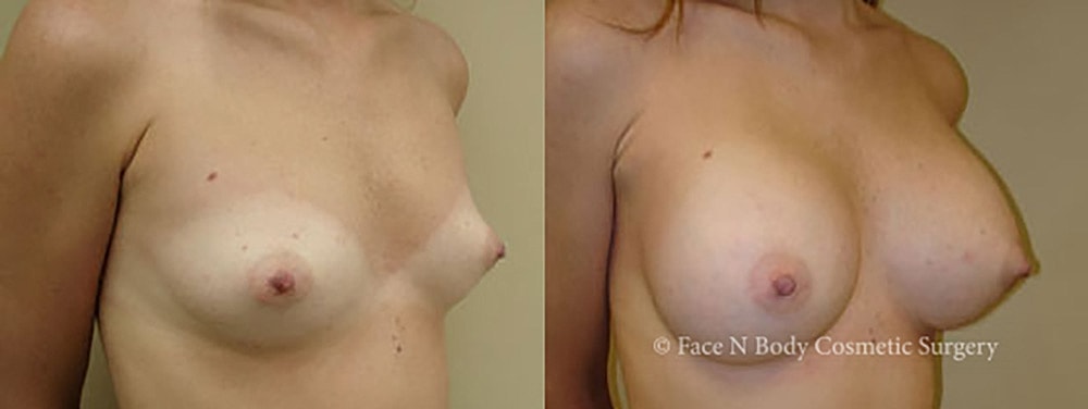 Breast Augmentation Before & After
