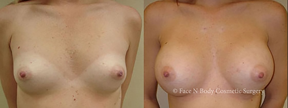 Breast Augmentation Before & After
