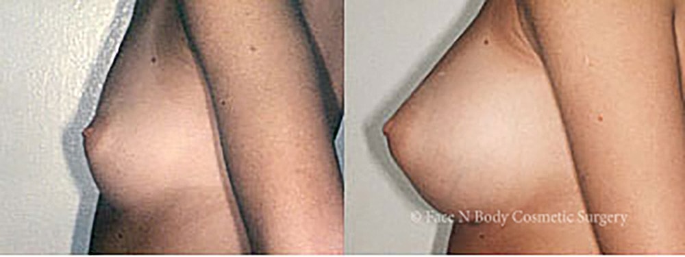 Breast Augmentation Before & After