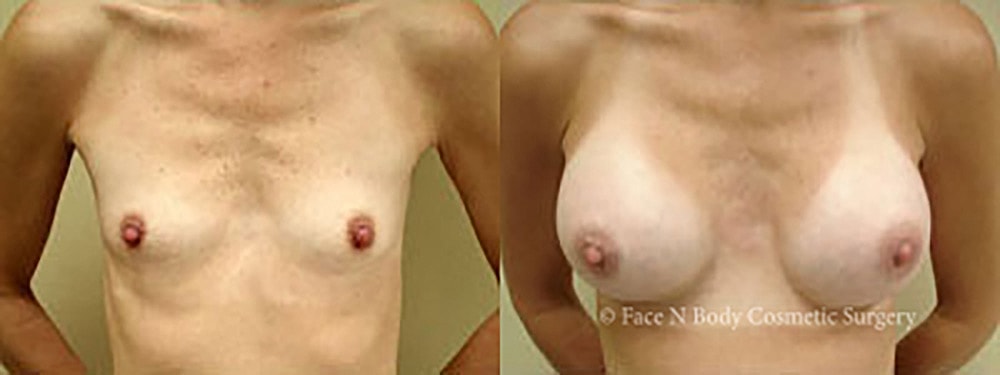 Breast Augmentation Before & After