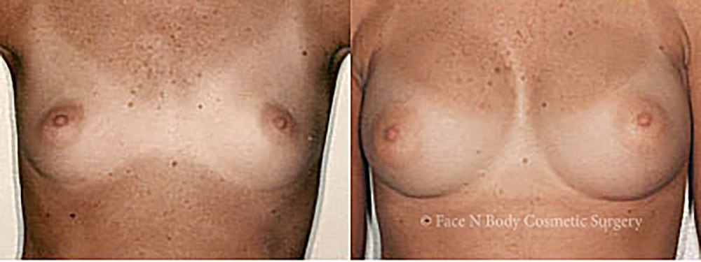 Breast Augmentation Before & After