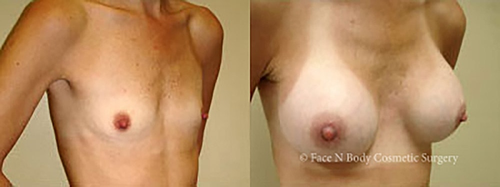 Breast Augmentation Before & After