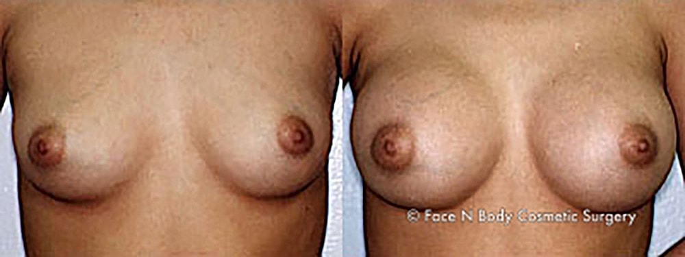 Breast Augmentation Before & After