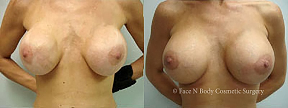 Breast Augmentation Before & After