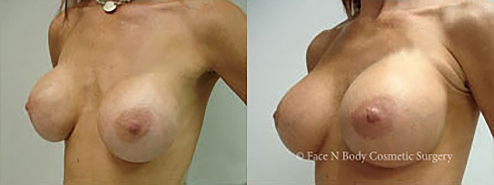 Breast Augmentation Before & After