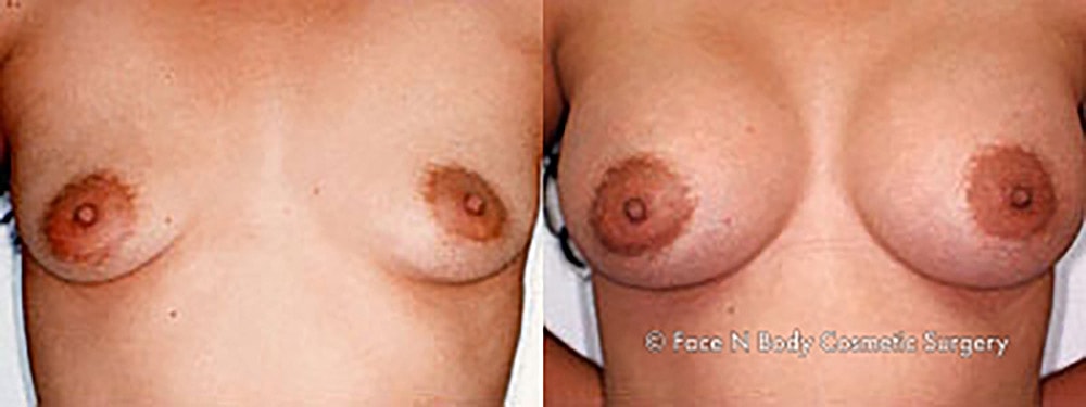 Breast Augmentation Before & After
