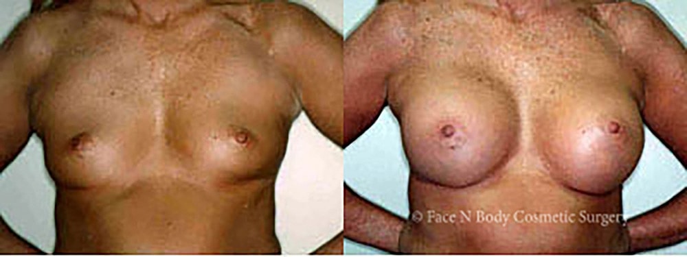 Breast Augmentation Before & After