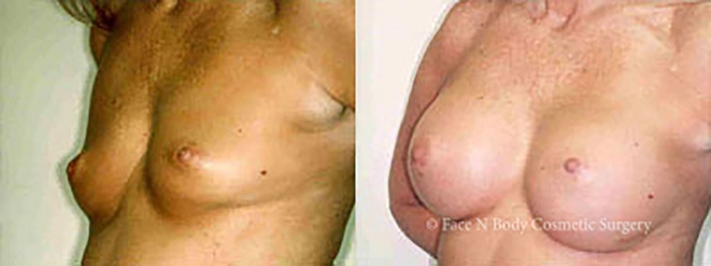 Breast Augmentation Before & After