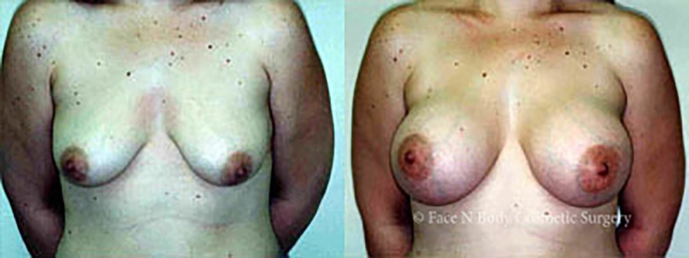 Breast Augmentation Before & After