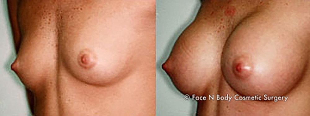 Breast Augmentation Before & After