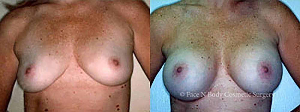 Breast Augmentation Before & After