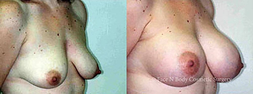 Breast Augmentation Before & After