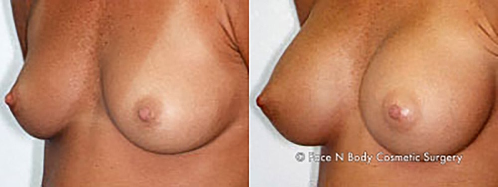 Breast Augmentation Before & After