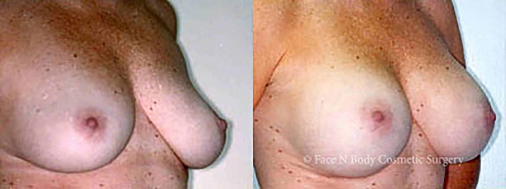 Breast Augmentation Before & After