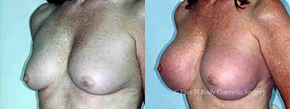 Breast Augmentation Before & After
