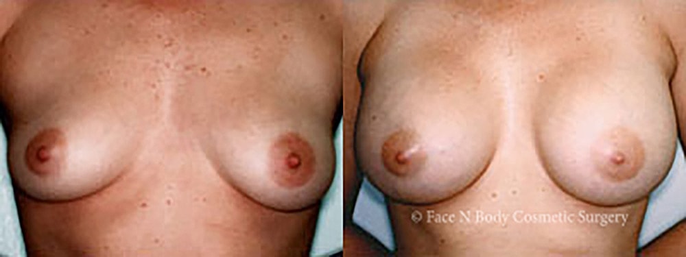 Breast Augmentation Before & After