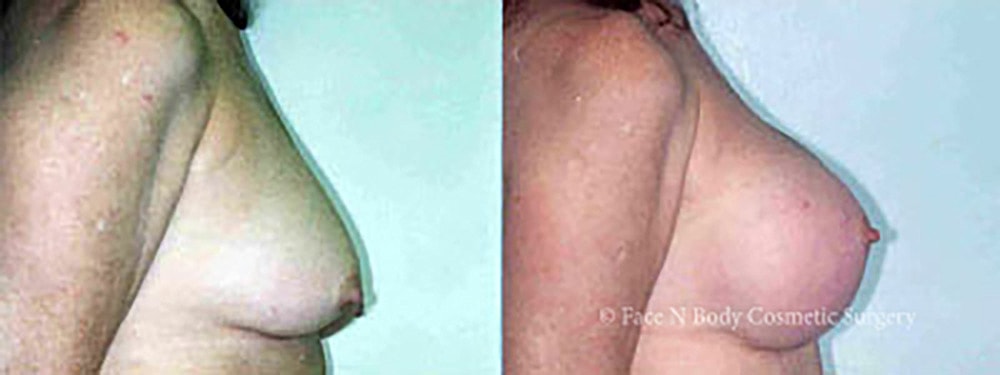 Breast Augmentation Before & After