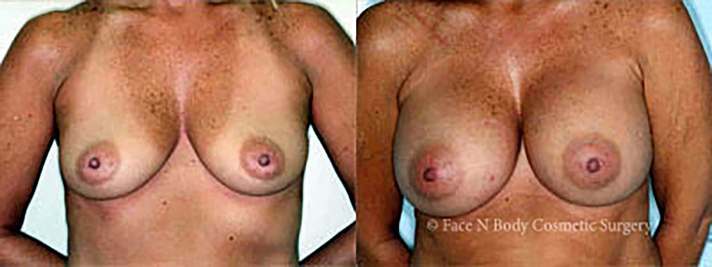 Breast Augmentation Before & After